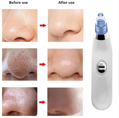 Electric Blackhead Remover Facial Cleansing Device