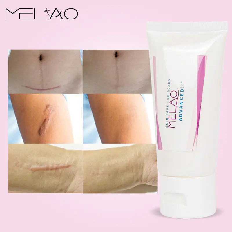 MELAO Scar Removal Gel for Stretch Marks and Acne Repair